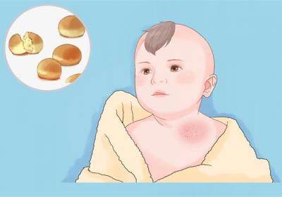 寶寶肺炎的癥狀有哪些癥狀