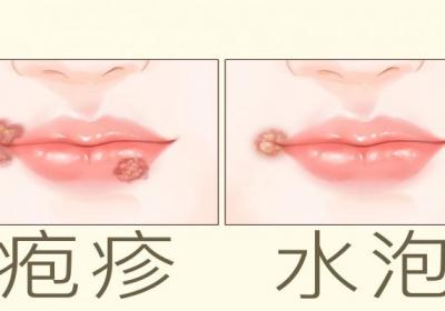 爛嘴角怎么辦最快最有效