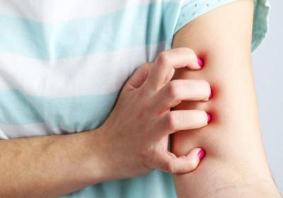 怎樣預防玫瑰糠疹呢