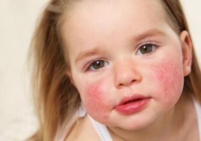 寶寶臉上有紅色胎記怎么辦 治療寶寶胎記可用4個方法